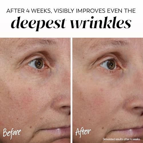 Before and after comparison of wrinkles reduction after 4 weeks.